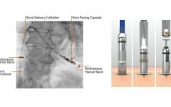 кардиостимулятор