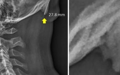 отростки черепа