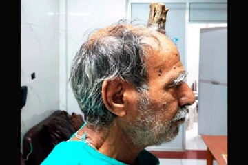Жителю Индии удалили 10-сантиметровый рог: фото