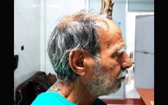 Жителю Индии удалили 10-сантиметровый рог: фото